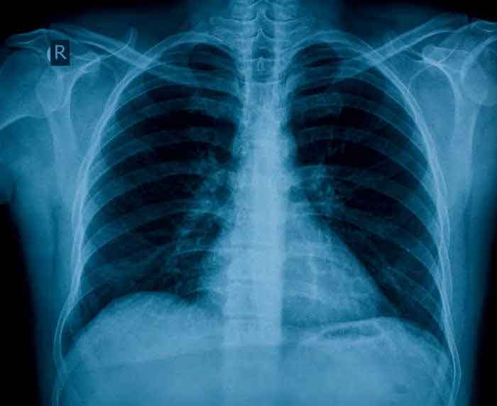 radiografia di parte superiore di un corpo, pronta per lo smaltimento